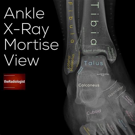 Develop a system for reviewing the ankle X-ray mortise view – swipe left for a full explanation ...