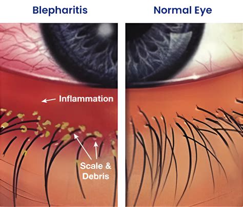 Chalazion Healing Stages