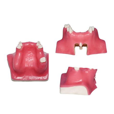 Dental Typodont Implant Tooth Model Medical Training Dental Implant ...