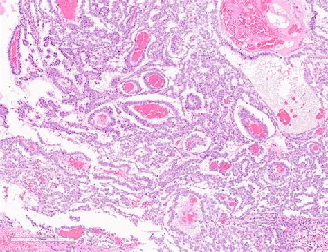 118A16 精巣腫瘍の対応、代表的な精巣腫瘍の組織像の提示 – 病理の広場