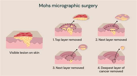Mohs micrographic surgery: Treatment and recovery