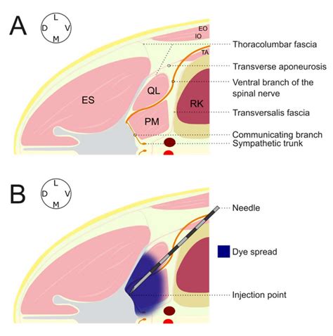 Evaluation of High-Volume Injections Using a Modified Dorsal Quadratus ...