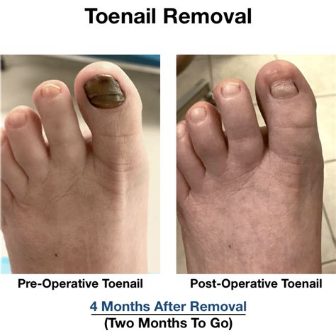 Full Toenail Extraction 的图像结果