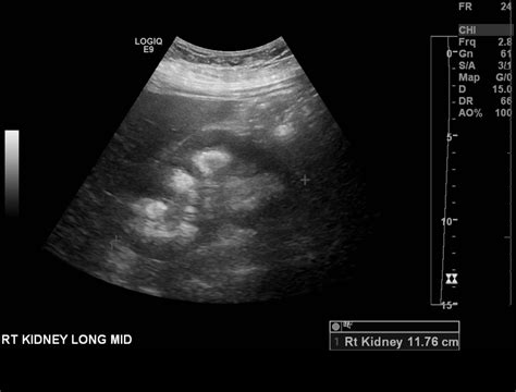 Medullary Sponge Kidney Ultrasound Appearance at Ryan Knight blog