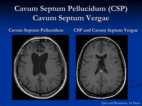 PPT - Intracranial Cysts: Diagnosis and Management Overview PowerPoint ...