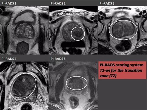 Presentation1, mri imaging of the prostate | PPTX