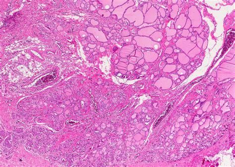 Thyroglossal Duct Cyst Histology Thyroglossal Duct Anomalies In