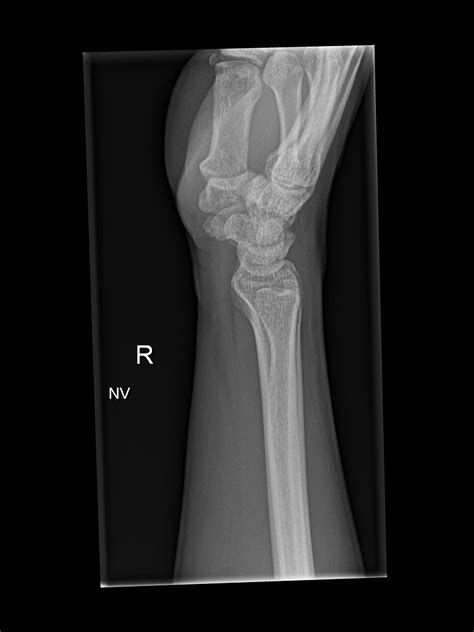 Normal Wrist Radiograph Colles fracture. Lateral (a) and AP (b) wrist ...