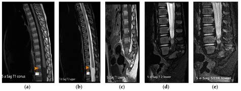 Caudal Regression Syndrome