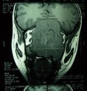 Endonasal hemangiopericytoma in child | Pediatric Oncall Journal