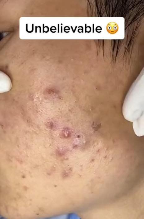 Image result for Cyst Extraction Videos