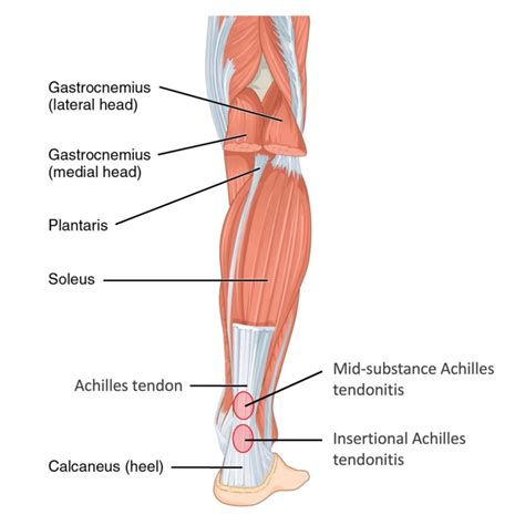 Achilles Tendon Pain: How To Spot And Treat Injuries – FDOMF