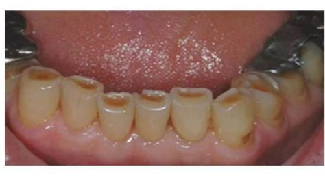 ATTRITION OF TEETH (Regressive Alterations of Teeth) | PPTX