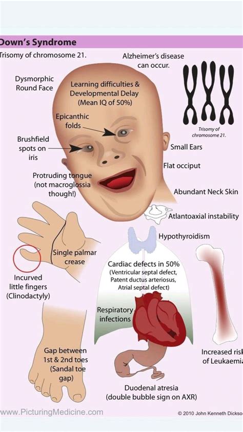 27/100 Down syndrome 👶 A genetic chromosome 21 disorder causing developmental and intellectual ...