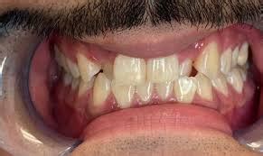 Image result for Abscessed Tooth Explosion