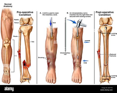 Fracture of tibia and fibula hi-res stock photography and images - Alamy