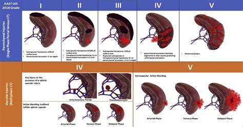 CT of blunt splenic injuries: what the trauma team wants to know from ...