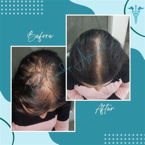 Treatment Gallery - Dr. Sandip Agrawal