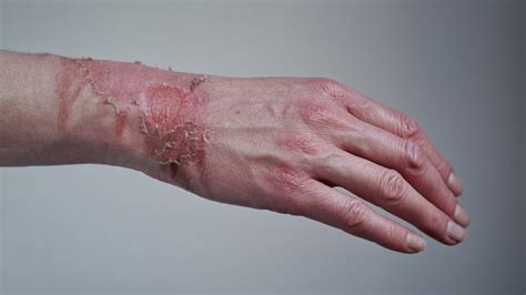 KDVMA | Understanding Military Burn Scars | Causes & Prevention Guide