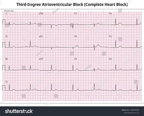 Third Degree Av Block Third Degree Heart Block | Causes, Symptoms, And