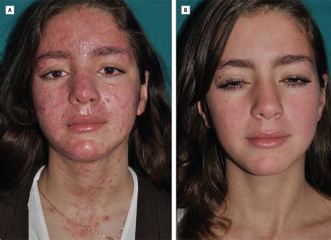 Demodex-Associated Oculocutaneous Rosacea | Adolescent Medicine | JAMA Dermatology | The JAMA ...