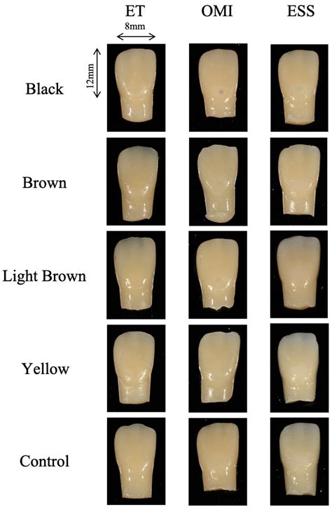 Visibility of Recurrent Caries Through Universal Shade Resin Composite ...