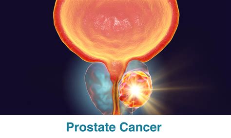 Prostate Cancer 的图像结果