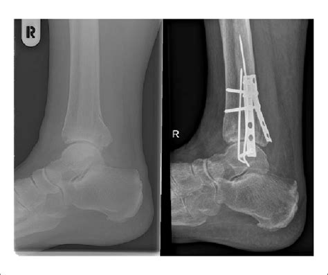 Ankle fracture with posterior malleolar fracture fragment fixed by ...