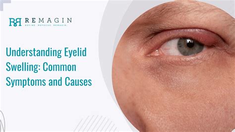 What Causes Swelling Under The Eyelid at Dianna Wagner blog