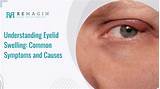 Understanding Eyelid Swelling: Common Symptoms and Causes | Remagin