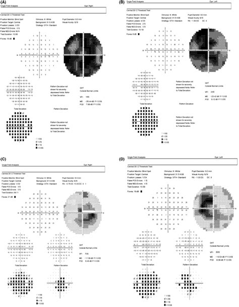 Image result for Contralateral Visual Field