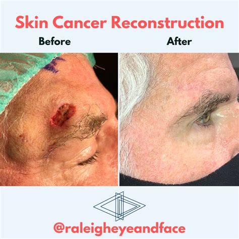 Raleigh Eye and Face Plastic Surgery - Raleigh Eye and Face Plastic Surgery - Serving Raleigh ...