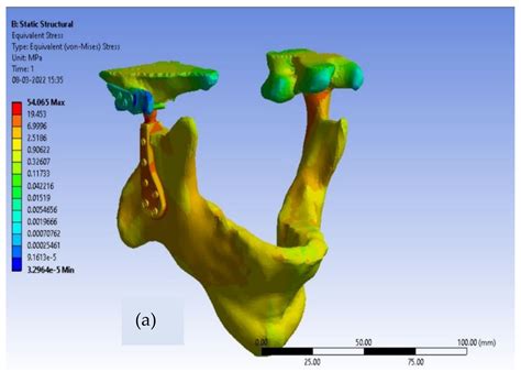 Biomechanical Analysis of Patient-Specific Temporomandibular Joint ...