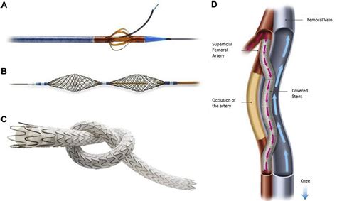 One-year results from the DETOUR I trial of the PQ Bypass DETOUR System ...