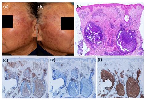 Clinical and Histopathological Characteristics of Cutaneous Lymphoid ...