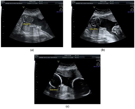 Single Fetal Demise in Twin Pregnancy—A Great Concern but Still a Favorable Outcome