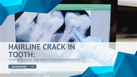 Hairline Crack in Tooth: Symptoms, Risks, and When to Get Seen