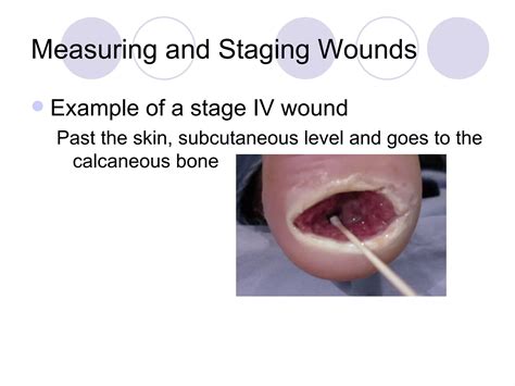Wound Measuring And Staging Inservice | PPT