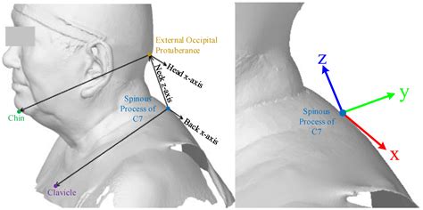 Anatomical-Based Customized Cervical Orthosis Design in Automation