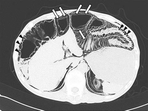 Pneumatosis Cystoides Intestinalis