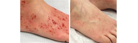Ultra Healing Cream (for Dry/ Cracked skin, Psoriasis or Eczema Patche ...