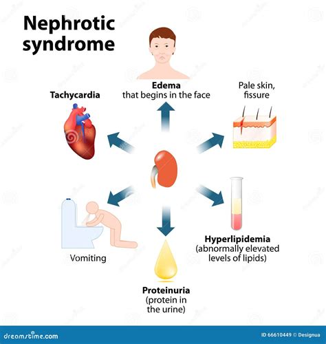 Nephrotic syndrome stock vector. Illustration of damage - 66610449