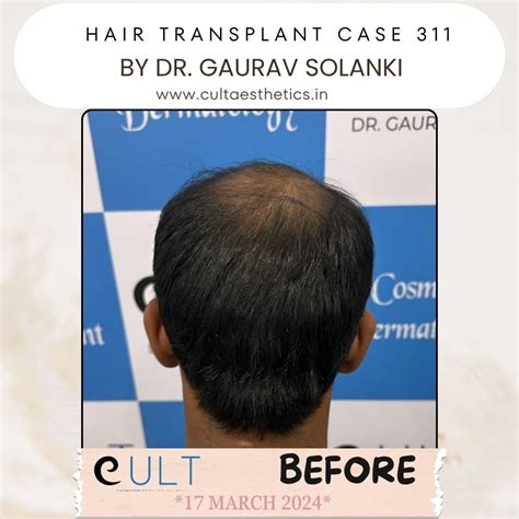 Hair Transplant Results 311 | Cult Aesthetics