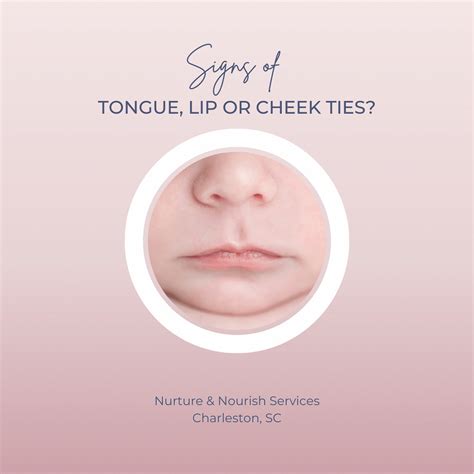 Baby Tongue Tie (Ankyloglossia) — Lactation Consultant Charleston, SC