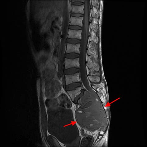 Spinal Cancer Life Expectancy at Denise Sanchez blog