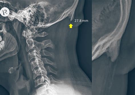 Study: Young People are Developing ‘Hornlike Spikes’ at Back of Their Skull Due to Poor Posture ...