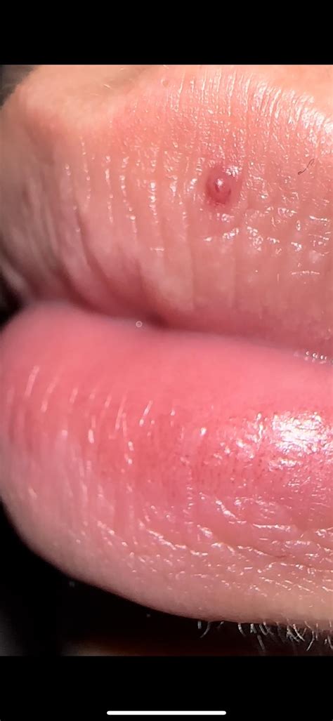 Got a weird bump in my lip, can anyone tell me what it is? Im a 14 year ...