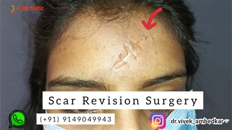 Scar Removal Surgery | Scar Revision | Face Scar | Patient From Gwalior ...