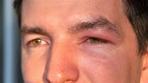 Puffy eyes that won’t go away? Why it could signal kidney trouble, and ...