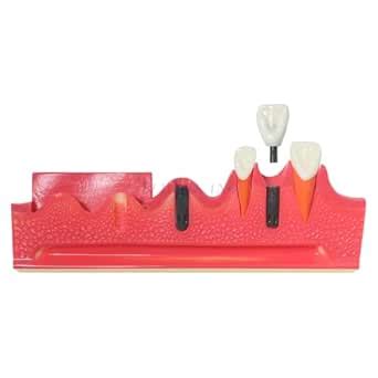 Dental Implant Model Tooth Show The Tooth Implant Process and Progress ...